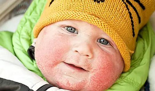 Атопический дерматит у ребенка: все, что нужно знать