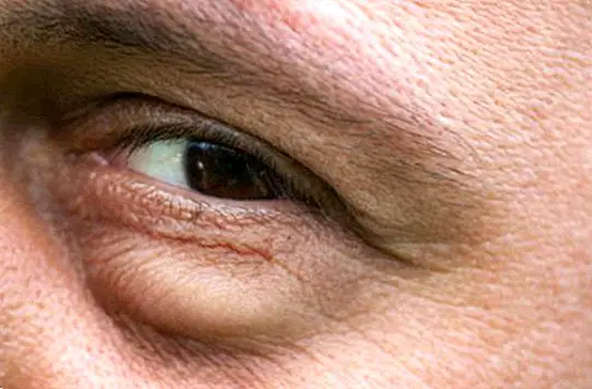 skjønnhet - 8 tips og rettsmidler for å forhindre øyepusthet
