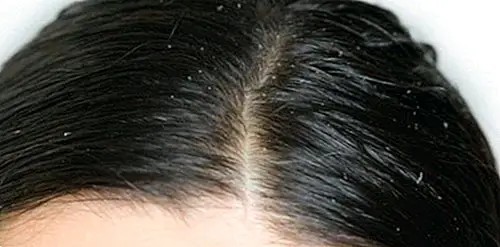 Saç yağını azaltmak için doğal ipuçları