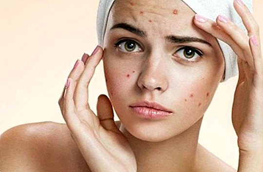 Juvenile acne: symptoms, causes and treatment - beauty