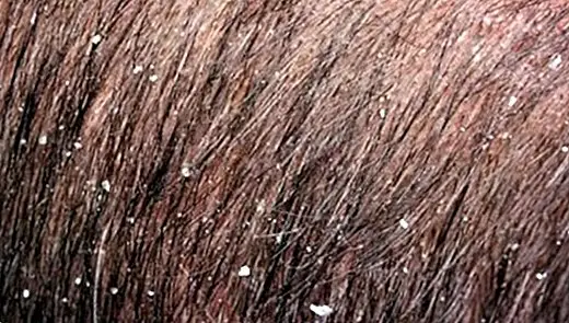 Zakaj se v laseh pojavi prhljaj: njegovi glavni vzroki