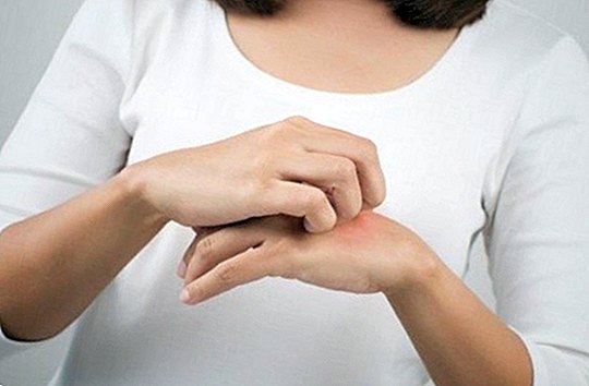 How to relieve dermatitis naturally