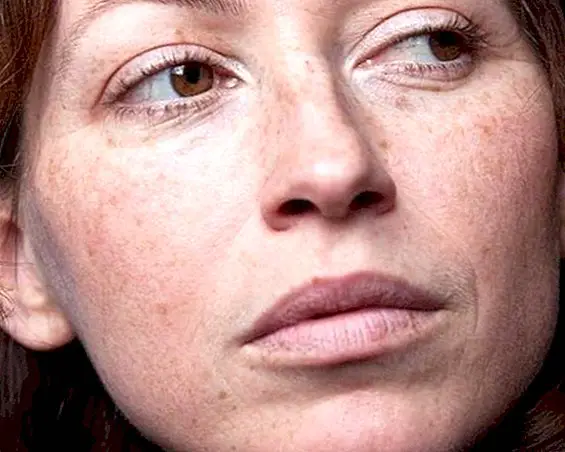 Why dark spots appear on the skin - beauty