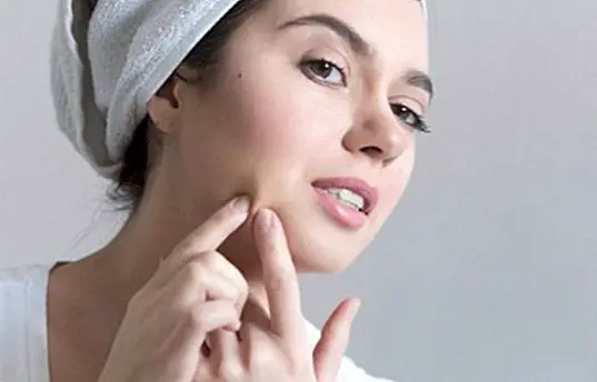 Why acne appears in adolescence and prevention - beauty