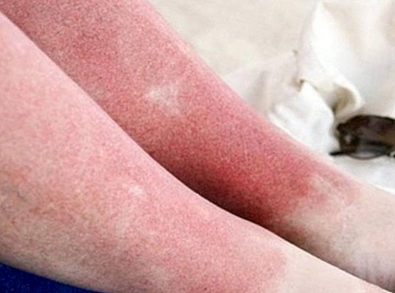 Opdater din hud efter solbadning med disse midler - skønhed
