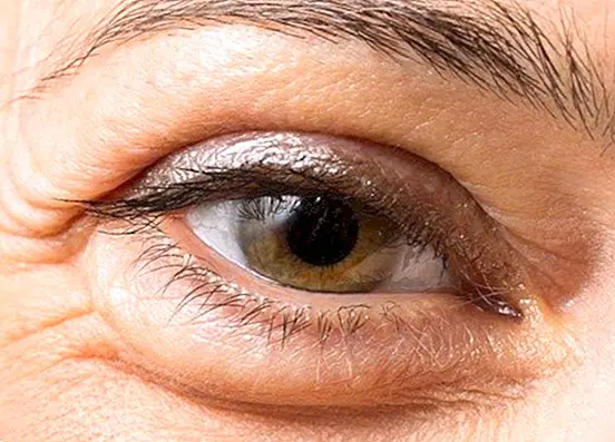 Como melhorar as olheiras e reduzir o inchaço sob as bolsas nos olhos com esses remédios - beleza