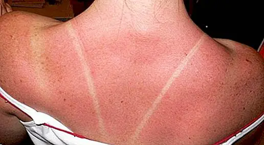 Natural tips to treat sunburn