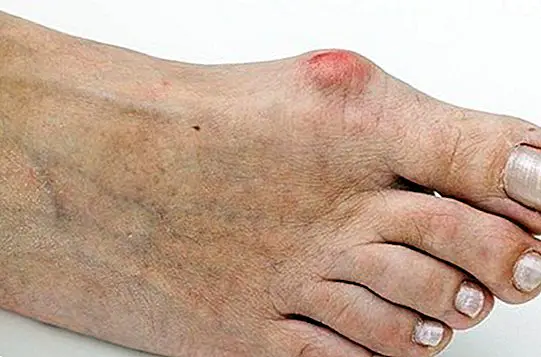 How to relieve the pain of bunions - healthy tips