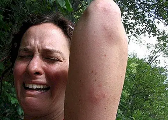 Hvorfor mosquito bites bid?