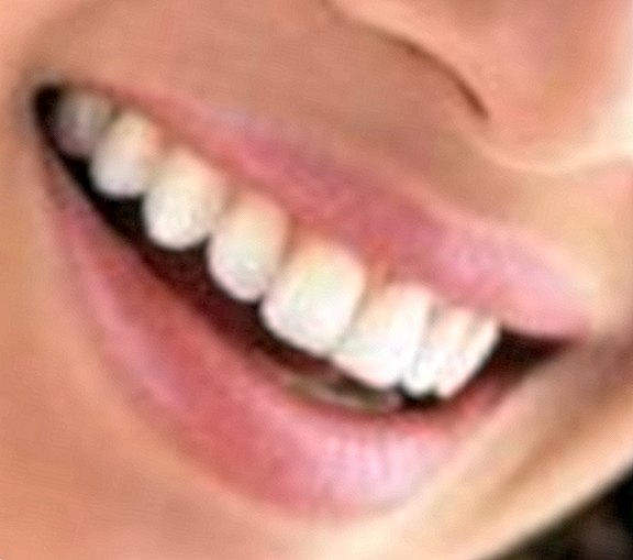 Whiter teeth