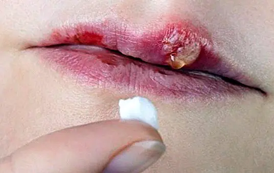 口唇ヘルペス：それは何ですか、症状、原因と治療 - 珍品