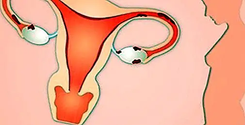 Poate ingrasa endometrioza?