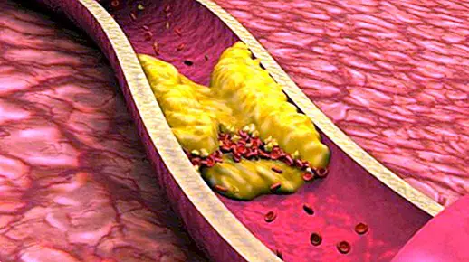 Geneettinen kolesteroli (perheperäinen hyperkolesterolemia): mikä se on, syyt ja hoito