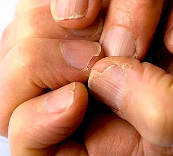 Breekbare nagels: waarom ze verschijnen en hoe ze op een natuurlijke manier te behandelen