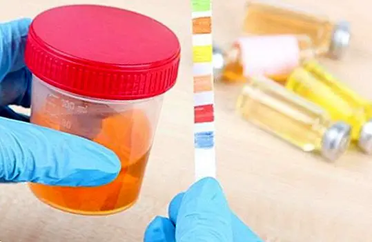 Barva urina in njegov medicinski pomen