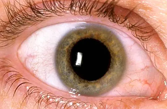 A diabéteszes retinopátia