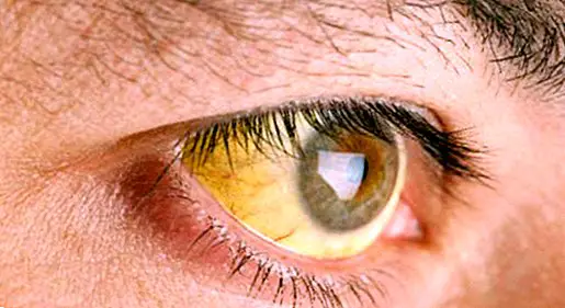 Jaundice: what it is, causes, symptoms and treatment