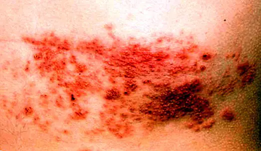 Herpes zoster (gordelroos): wat is het, symptomen, oorzaken en behandeling