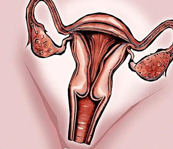 Vaginal candidiasis, a silent disease that only needs control - diseases