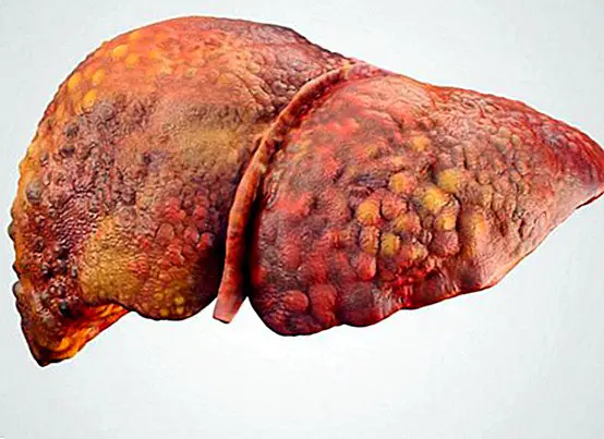 Karaciğer sirozu: ne olduğu, nedenleri, belirtileri, çeşitleri ve tedavisi