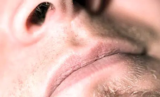 Polip hidung (jisim atau pelet di hidung): apa yang mereka, gejala dan rawatan