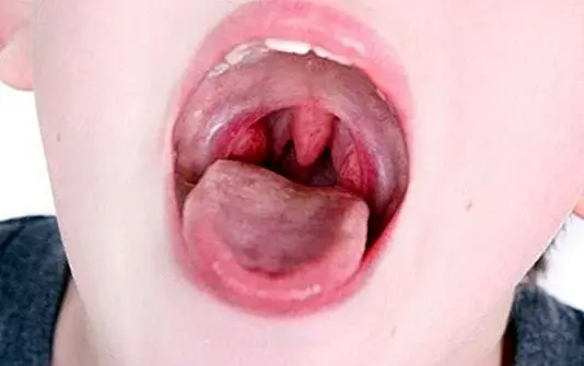 Removal of the tonsils: when and why it is done - diseases