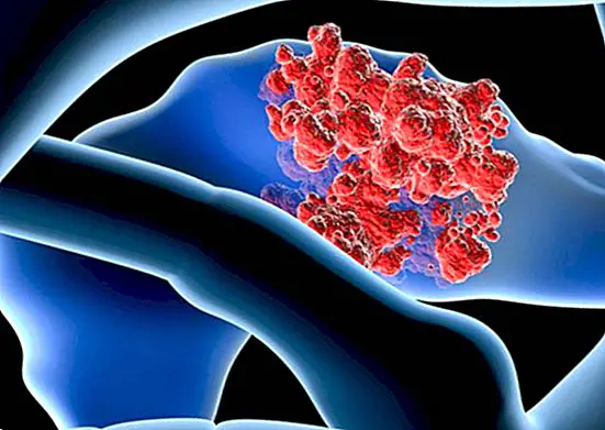 sygdomme - Bukspyttkjertelkræft: hvad det er, årsager, symptomer og behandling