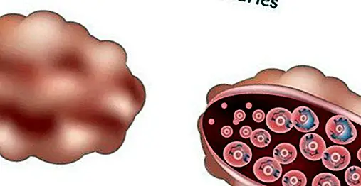 Ovariálna polycystóza: príznaky, príčiny a lekárske ošetrenie