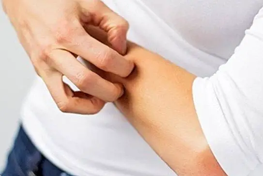 Dermatite atópica: sintomas, causas e tratamento - doenças
