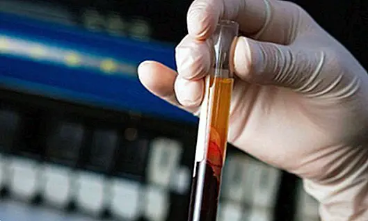 Kaip kraujo tyrimas gali aptikti 8 vėžio tipus - medicininiai tyrimai