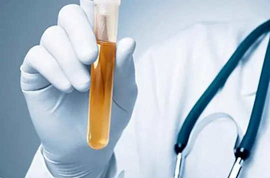 The bilirubin in urine - medical tests