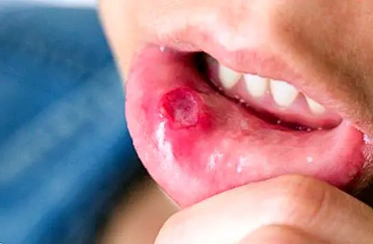 How to prevent and cure mouth sores with natural remedies - Natural medicine