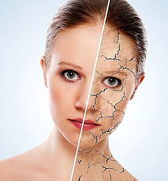 Wie Sie die Hautrisse mit natürlichen Mitteln verbessern - natürliche Heilmittel