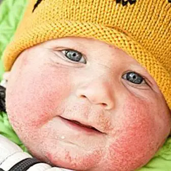 Dermatite atópica no bebê: tudo que você precisa saber