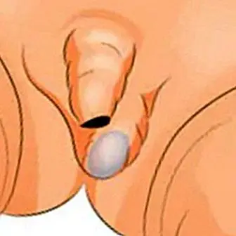Cryptorchidie: le testicule n'est ni descendu ni caché. Causes, symptômes et comment est-il traité