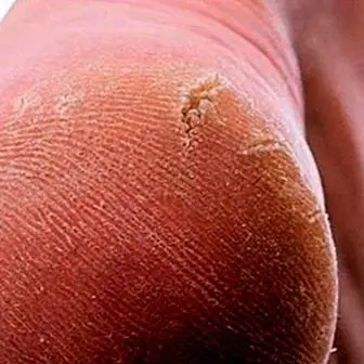 Why calluses appear on feet and hands
