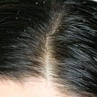 Petua semulajadi untuk mengurangkan gris rambut