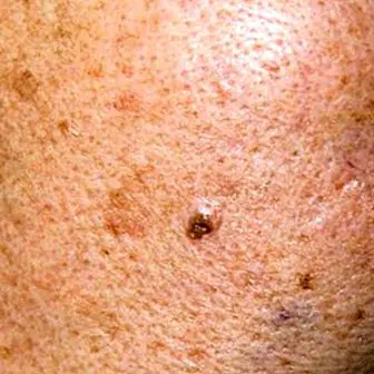 What is melasma and why does it appear?