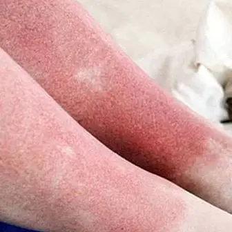 Opdater din hud efter solbadning med disse midler