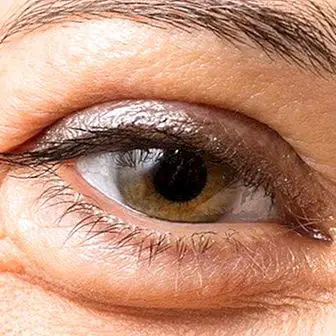 วิธีการปรับปรุงคล้ำและลดอาการบวมใต้ถุงใต้ตาด้วยการเยียวยาเหล่านี้