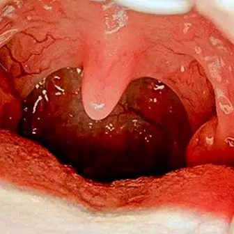 Advice and care after removal of the tonsils or tonsils