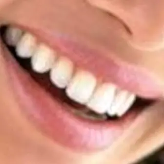 Fehérebb fogak
