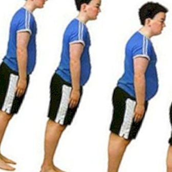 Ikke behandling av fedme i tid reduserer forventet levealder fra 15 til 20 år