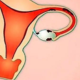 Dor menstrual, infertilidade e dor nas relações sexuais: o que causa esses sintomas