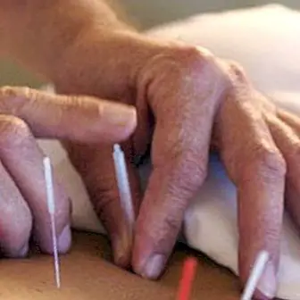 L'acupuncture, efficace pour soulager la douleur