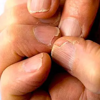 Fragile negle: hvorfor de ser ud og hvordan man behandler dem naturligt