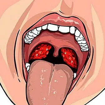 Tonsilitída: príznaky, príčiny a liečba