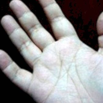Mravljinčenje v rokah in sindrom karpalnega kanala