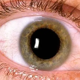 Diabetična retinopatija: kaj je, simptomi, vzroki in zdravljenje