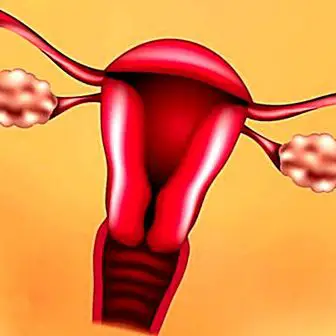 Polycystic ovary syndrome: what it is, symptoms, causes and treatment